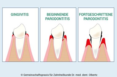 Was ist der Unterschied zwischen Parodontitis und Gingivitis? 
