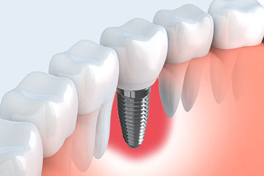 Verliere ich mein Implantat bei entzündetem Zahnfleisch? 