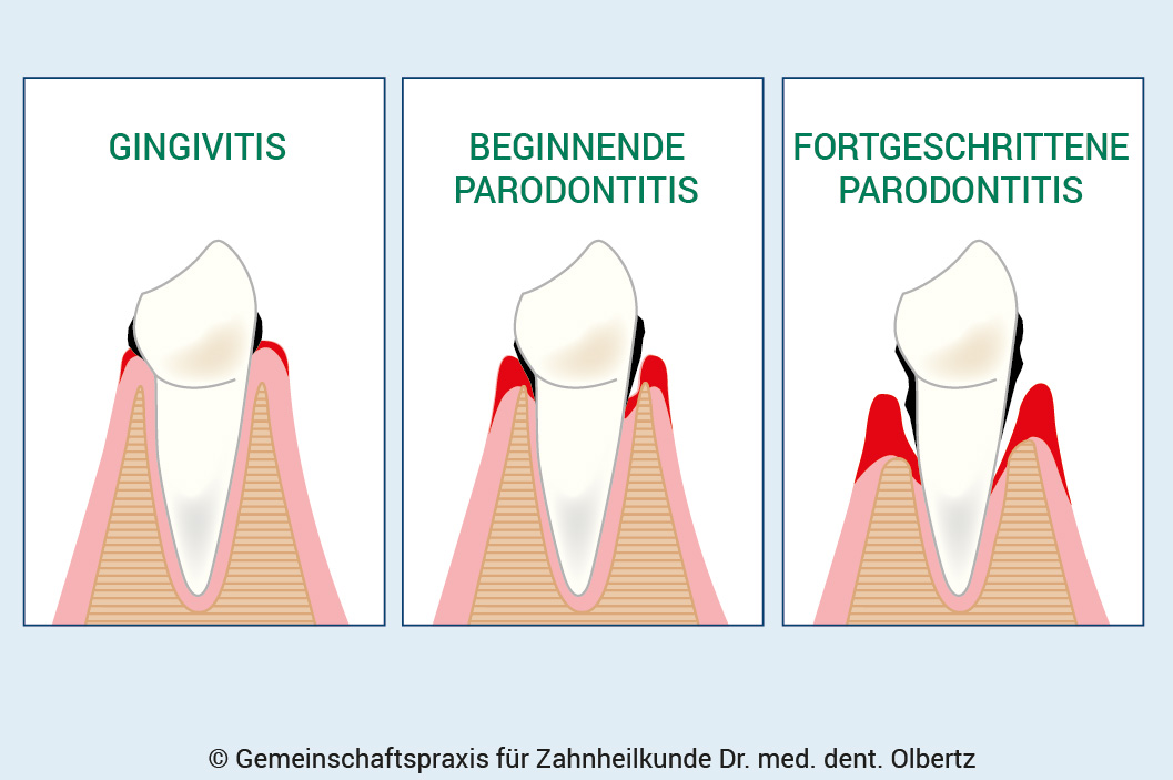 Was ist der Unterschied zwischen Parodontitis und Gingivitis?
