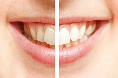 Professionelle Zahnreinigung für schöne Zähne 